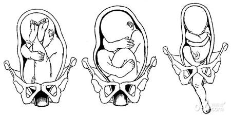 图文解读胎位不正的各种情况