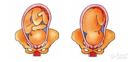 图文解读胎位不正的各种情况
